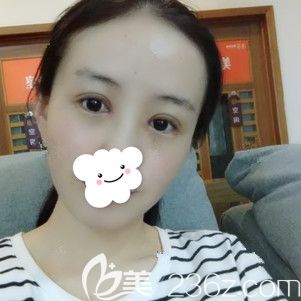 一周拆线后眼部肿胀基本消退