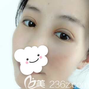 十天眼综合恢复情况