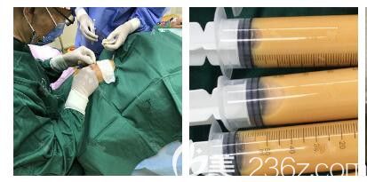 自体脂肪全脸填充手术中 自体脂肪全脸填充手术中