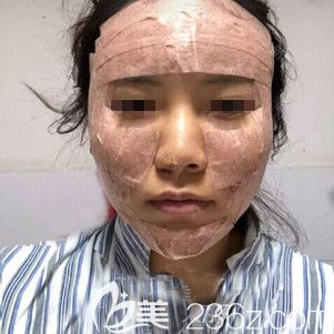 刚做完自体脂肪全面部填充<span style= 刚做完自体脂肪全面部填充<span style=