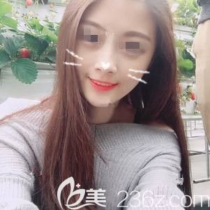 虽然快一万的自体脂肪填充比线雕价格贵，但是选对常州美贝尔专业医院术后没有后遗症成活率还高