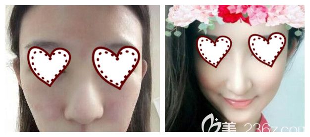 南宁东方整形赵波院长鼻整形失败修复案例