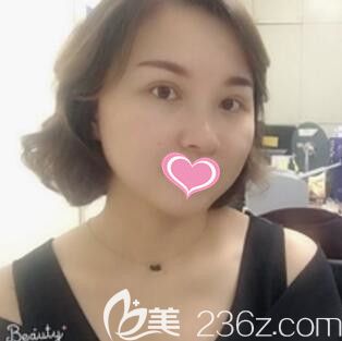 长沙华韩华美好不好？真人埋线提升术后18天<span style=