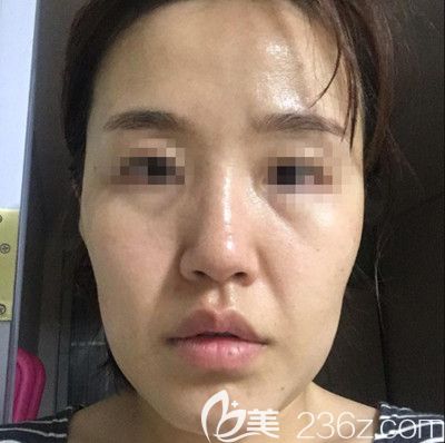 在韩国芭堂做面部埋线提升+自体脂肪填充术前 在韩国芭堂做面部埋线提升+自体脂肪填充术前