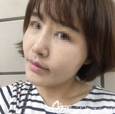 在韩国芭堂做面部埋线提升+自体脂肪填充术后9天 在韩国芭堂做面部埋线提升+自体脂肪填充术后9天