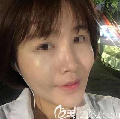 在韩国芭堂做面部埋线提升+自体脂肪填充术后2周 在韩国芭堂做面部埋线提升+自体脂肪填充术后2周