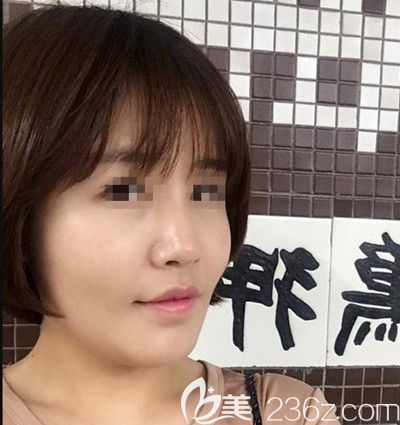 在韩国芭堂做面部埋线提升+自体脂肪填充术后1个月 在韩国芭堂做面部埋线提升+自体脂肪填充术后1个月