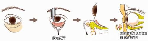 南京亚韩医生分享激光去眼袋原理