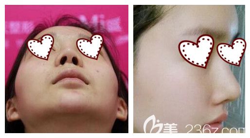 南宁东方整形假体隆鼻失败修复案例