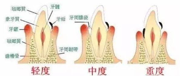 牙龈萎缩的各种情况 牙龈萎缩的各种情况