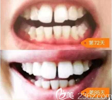 刚带隐适美牙套72天和第85天的照片