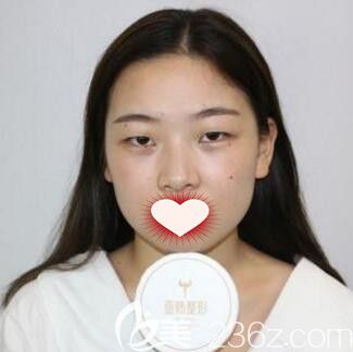 在长沙亚韩做眼综合术前照 在长沙亚韩做眼综合术前照