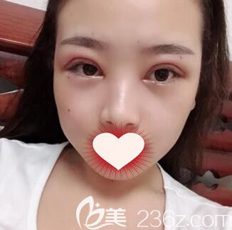 韩式切开双眼皮+开眼角术后2天照 韩式切开双眼皮+开眼角术后2天照