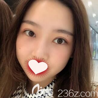 在长沙做双眼皮+开眼角术后20天效果 在长沙做双眼皮+开眼角术后20天效果