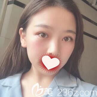 在长沙亚韩做双眼皮+开眼角术后30天效果 在长沙亚韩做双眼皮+开眼角术后30天效果