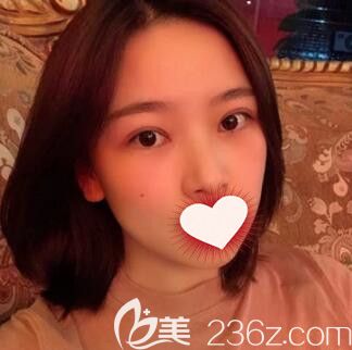 长沙亚韩谁做的双眼皮好？看我找郑京湘做的韩式切开双眼皮+开眼角术后50天恢复效果怎么样？