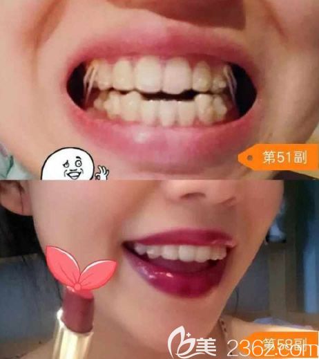 第51和58副牙套正在进行微调