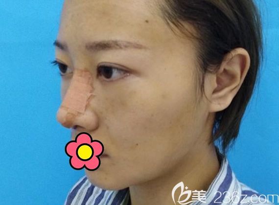 兰州仁和鼻综合隆鼻第三天图片