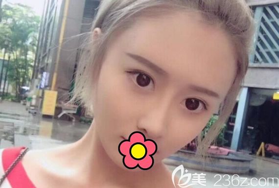 硅胶假体隆鼻+自体耳软骨隆鼻一个月恢复图