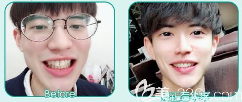 广州艺美袁媛主任半透明陶瓷托槽牙齿矫正案例 广州艺美袁媛主任半透明陶瓷托槽牙齿矫正案例