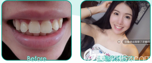 广州艺袁媛做的全透明隐形牙齿矫正案例对比图 广州艺袁媛做的全透明隐形牙齿矫正案例对比图