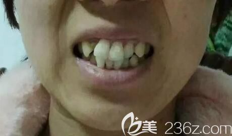 我在武汉德韩口腔做牙齿矫正前的照片 我在武汉德韩口腔做牙齿矫正前的照片