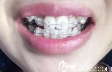 我在武汉德韩口腔做牙齿矫正第4个月 我在武汉德韩口腔做牙齿矫正第4个月