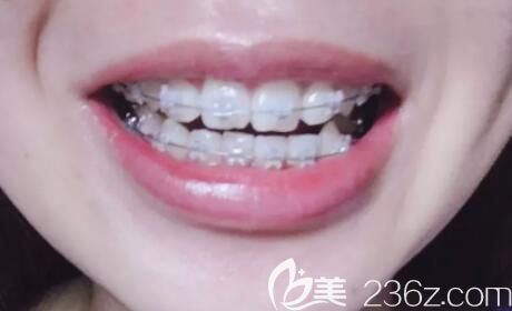 我在武汉德韩口腔做陶瓷托槽牙齿矫正第9个月 我在武汉德韩口腔做陶瓷托槽牙齿矫正第9个月