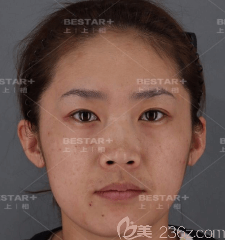 在北京上上相做自体脂肪面部填充前正面样子 在北京上上相做自体脂肪面部填充前正面样子