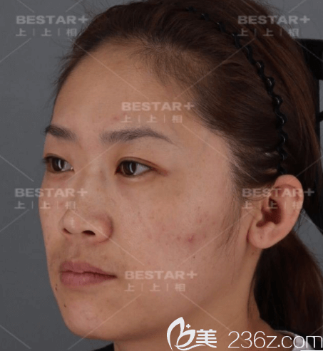 在北京上上相做自体脂肪面部填充前45度照 在北京上上相做自体脂肪面部填充前45度照