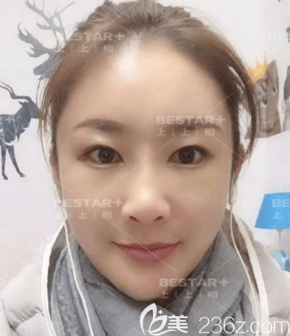 郑楚蓉医生给我做自体脂肪面部填充第15天样子 郑楚蓉医生给我做自体脂肪面部填充第15天样子