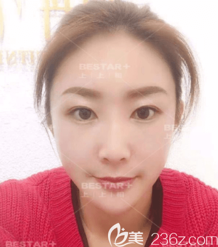 北京上上相自体脂肪面部填充案例 北京上上相自体脂肪面部填充案例