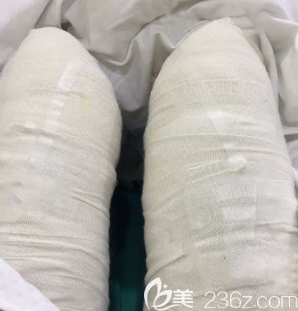 兰州仁和整形<!--<i data=20240703-sp></i>-->大腿抽脂第1天 兰州仁和整形<!--<i data=20240703-sp></i>-->大腿抽脂第1天