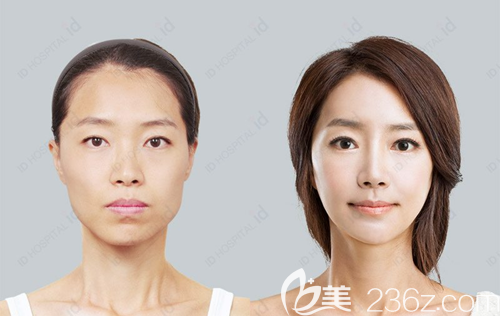 韩国ID整形医院面部轮廓三件套手术案例