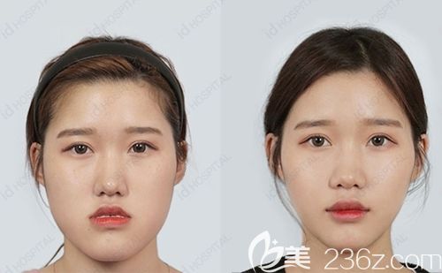 韩国ID双鄂手术案例
