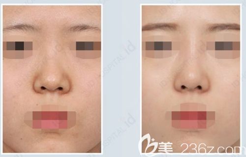 韩国id隆鼻手术案例