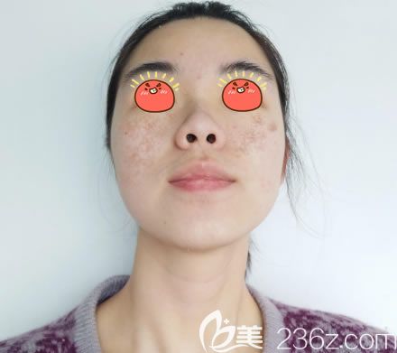 在绍兴维美医院做激光祛斑前 在绍兴维美医院做激光祛斑前