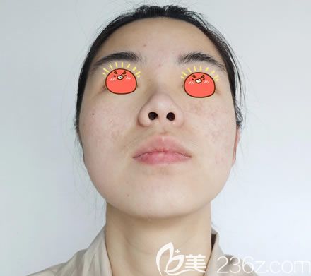 皮秒激光祛斑11天恢复效果图 皮秒激光祛斑11天恢复效果图