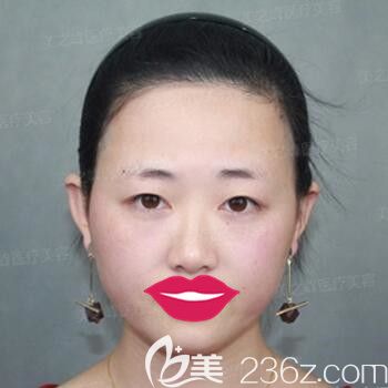 做双眼皮术前照 做双眼皮术前照