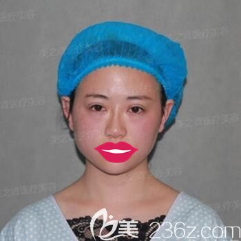 做TWO-DAYS双眼皮术后效果 做TWO-DAYS双眼皮术后效果