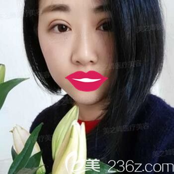 做双眼皮术后3天恢复效果程度 做双眼皮术后3天恢复效果程度