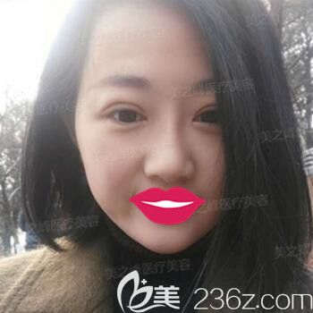 做TWO-DAYS双眼皮术后10天恢复效果 做TWO-DAYS双眼皮术后10天恢复效果