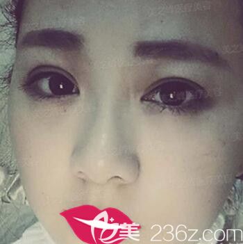 在美之峰做TWO-DAYS双眼皮术后2个月恢复效果 在美之峰做TWO-DAYS双眼皮术后2个月恢复效果