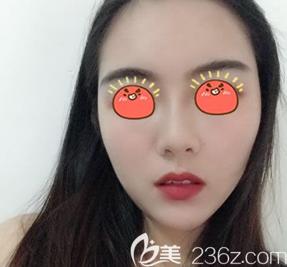 看本仙女3个月前找金华亚美邓泽臣做的吸脂加自体脂肪面部填充的效果怎么样