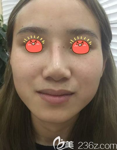 做隆鼻失败假体歪斜的照片 做隆鼻失败假体歪斜的照片