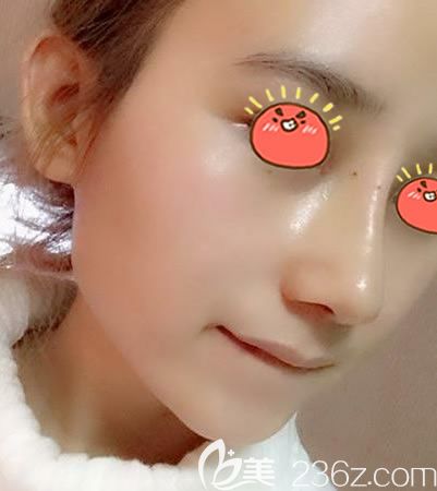 金华瑞丽整形鼻修复案例9天效果 金华瑞丽整形鼻修复案例9天效果