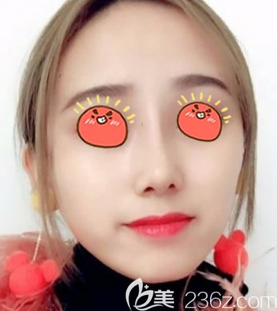 做完鼻综合修复手术30天后 做完鼻综合修复手术30天后