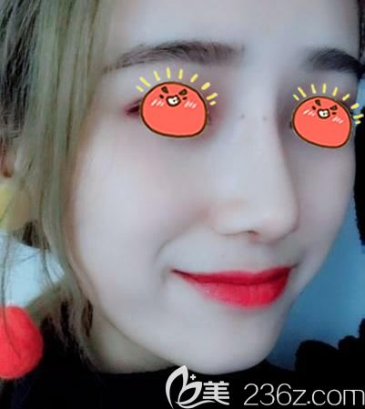 二次做隆鼻经历,金华瑞丽鼻综合修复手术结束我做隆鼻失败的噩梦!!!