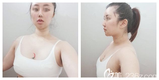 术前面诊南通维多利亚胸部较小 术前面诊南通维多利亚胸部较小