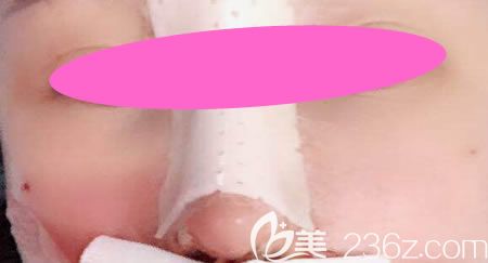 花9800元找景德镇艺美虞国锋做假体+半肋骨隆鼻术后第3天样子